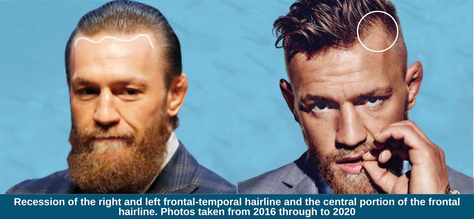 Conor McGregors Balding Struggles: The Truth Behind His Hair Loss