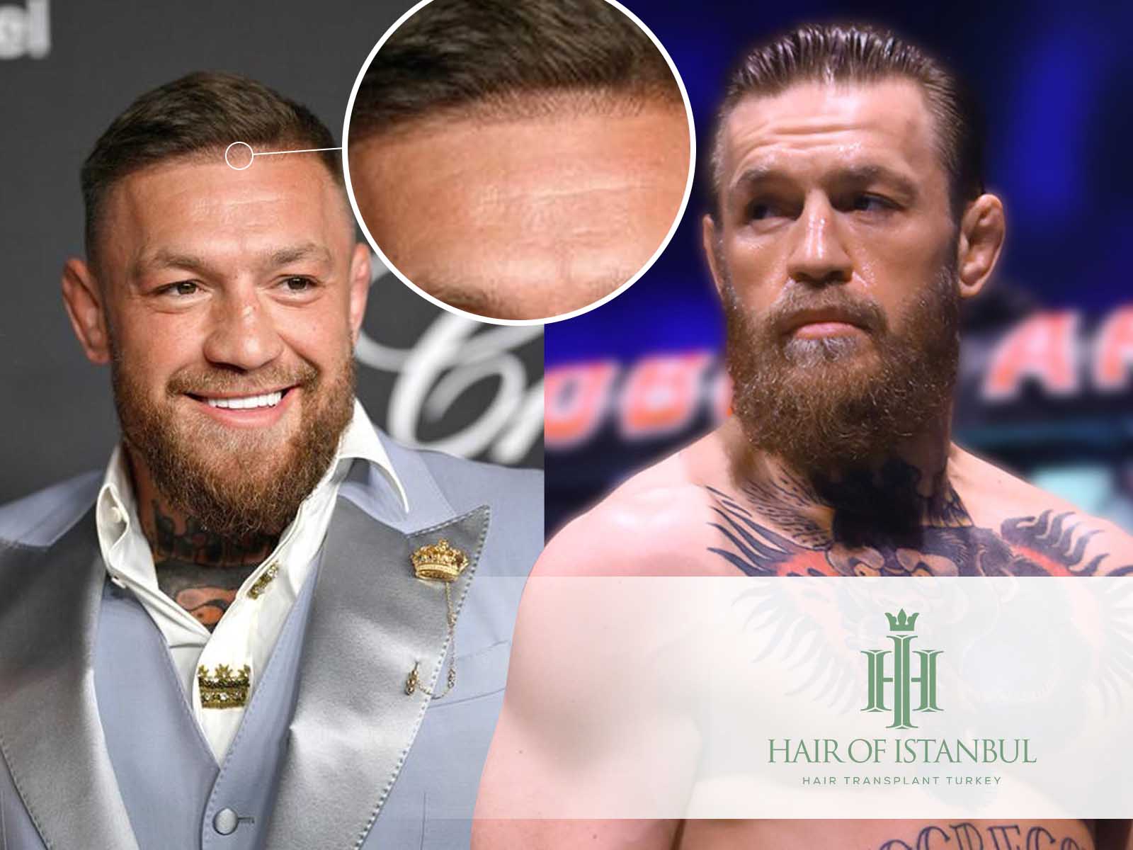 Conor McGregors Balding Struggles: The Truth Behind His Hair Loss