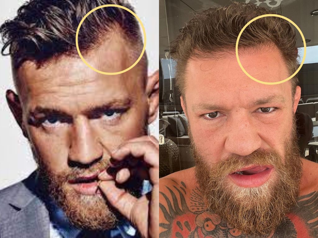 Conor McGregor Hair Transplant: Before and After Photos