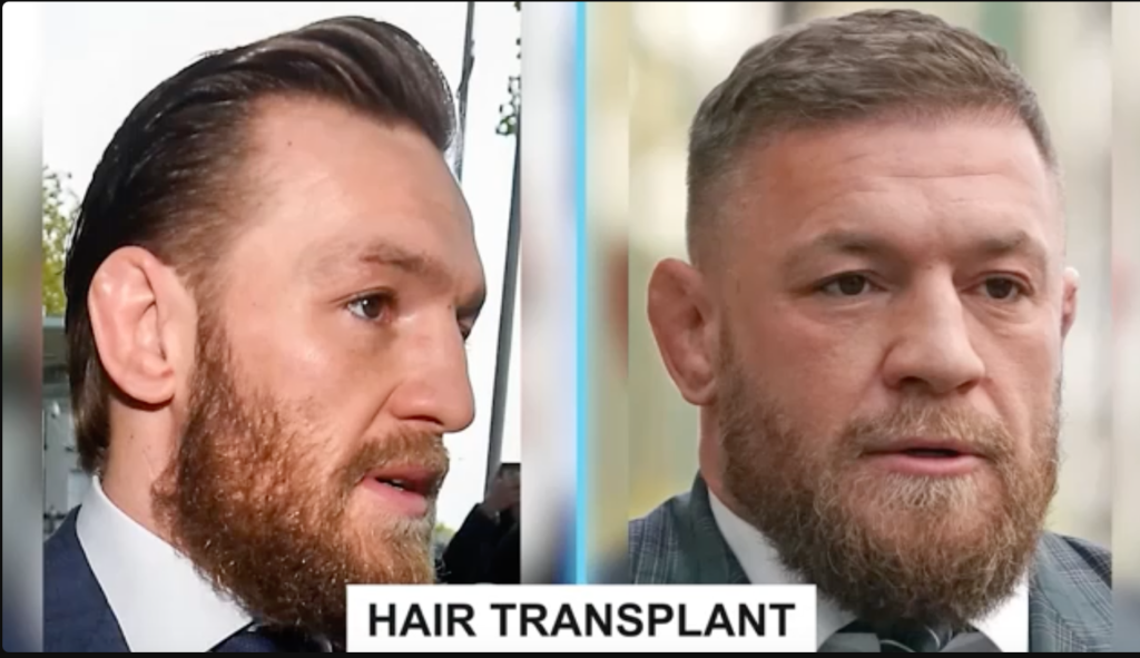 Conor McGregor Hair Transplant: Before and After Photos