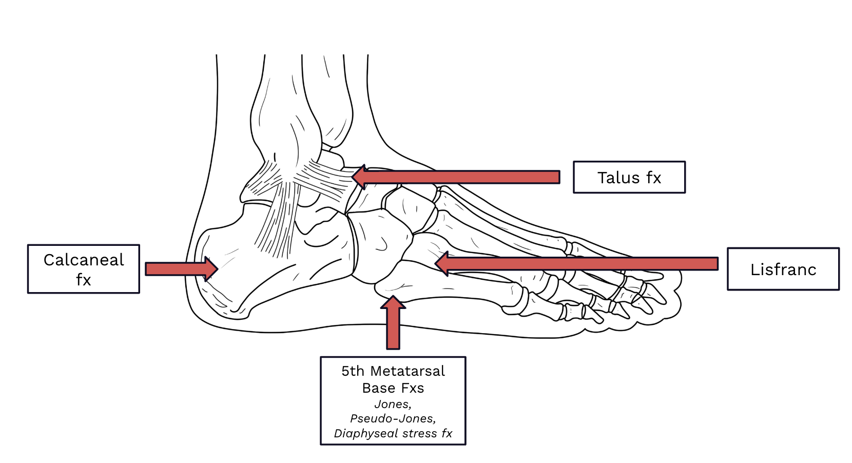 Understanding Pereira Foot Injury: Causes and What to Do